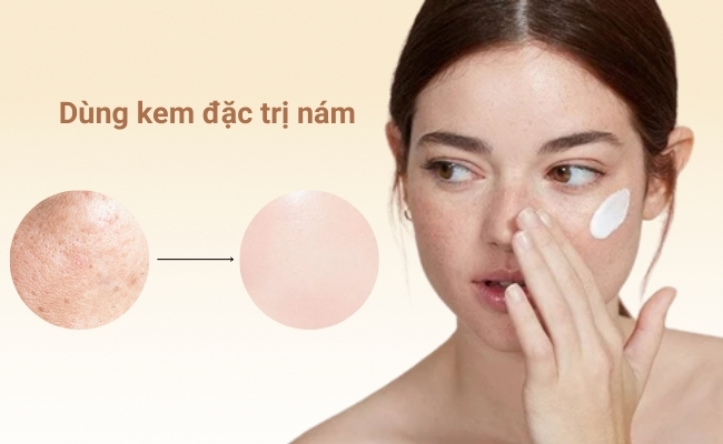 Cách trị nám bằng Tranexamic