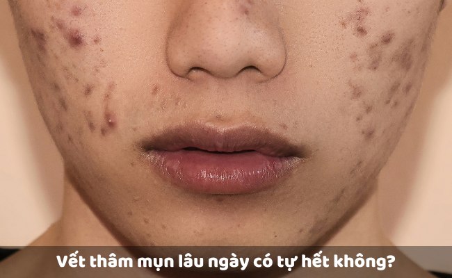 Vết thâm mụn lâu ngày có tự hết không?