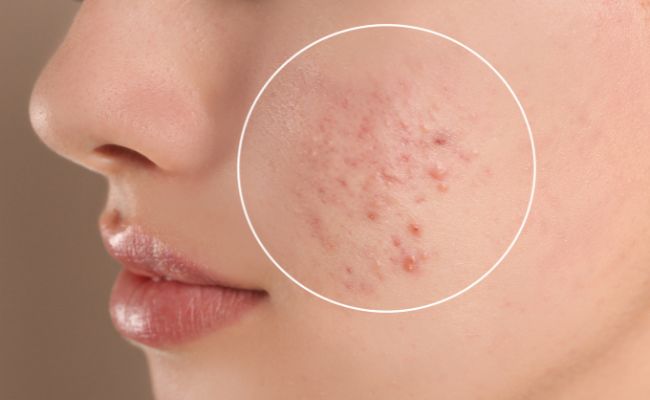 Mụn là gì? Nguyên nhân gây mụn