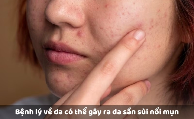 Bệnh lý về da có thể gây ra da sần sùi nổi mụn