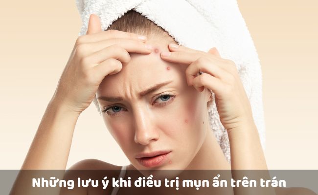 Những lưu ý khi điều trị mụn ẩn trên trán