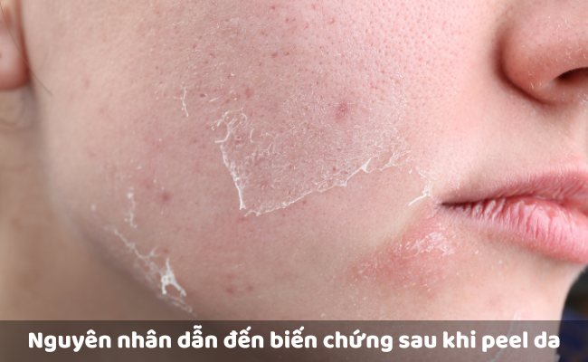 Nguyên nhân dẫn đến biến chứng sau khi peel da

