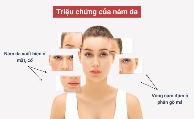 Dấu hiệu nhận biết của nám da là gì?