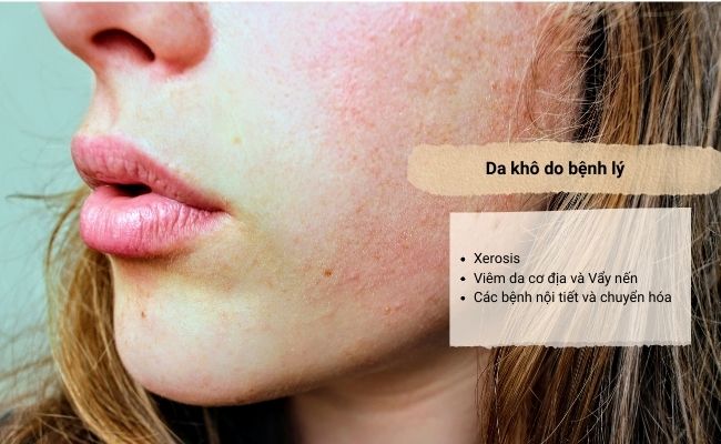 Nguyên nhân gây khô da là gì