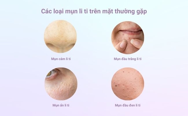 Mụn đầu đen li ti
