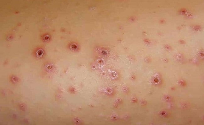 Mụn đỏ trên da là biểu hiện của Lichen phẳng

