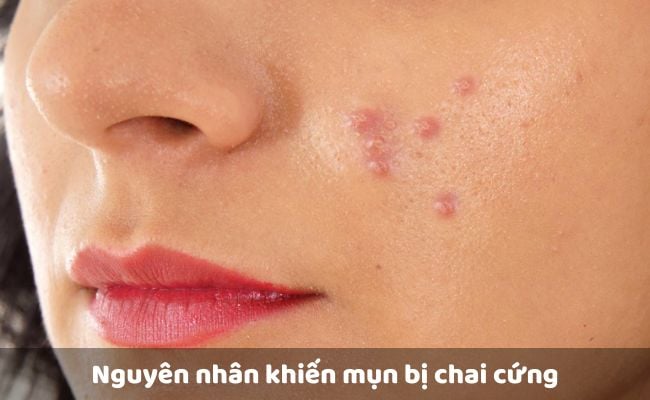 Nguyên nhân khiến mụn bị chai cứng