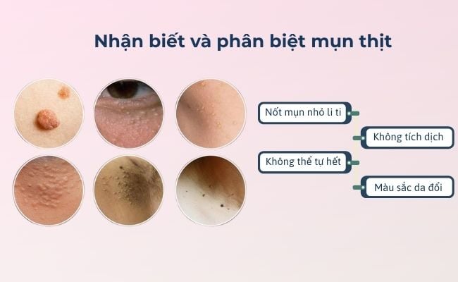 Dấu hiệu nhận biết mụn thịt