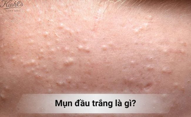 Mụn đầu trắng là gì?
