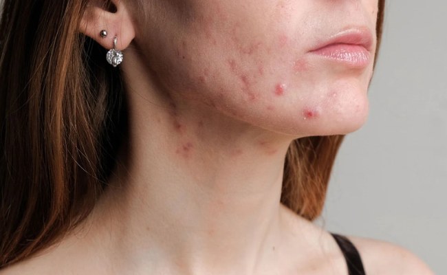 Mụn bọc là gì?