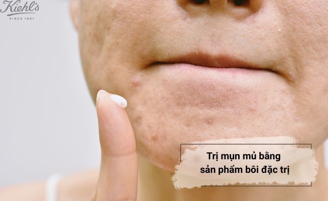 Cách trị mụn mủ tại nhà bằng thuốc, sản phẩm bôi đặc trị