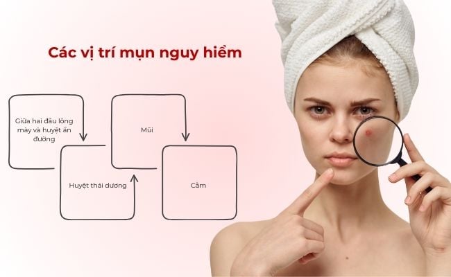 Các vị trí mụn nguy hiểm
