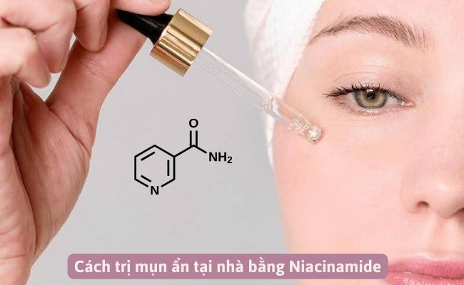 Mới nặn mụn xong nên làm gì để hết thâm sẹo?