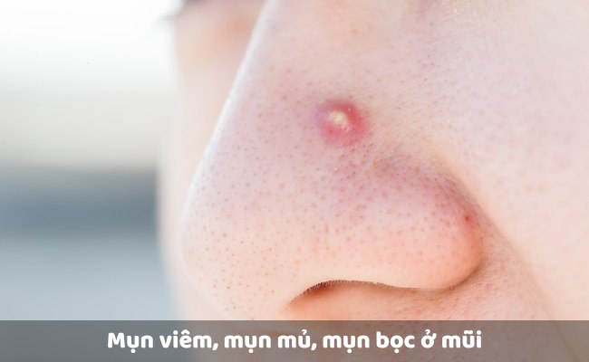 Mụn viêm, mụn mủ, mụn bọc ở mũi

