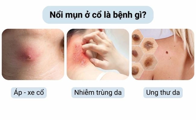 Tình trạng da nổi mụn ở cổ đôi khi là biểu hiện của các bệnh lý cần được chẩn đoán kịp thời.