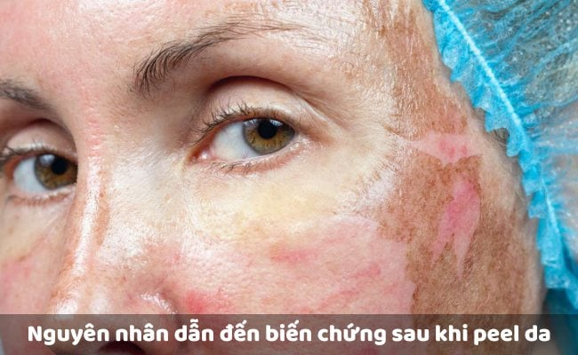 Những biến chứng sau khi peel da có thể xảy ra

