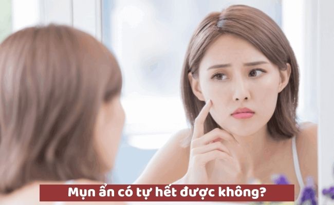 Mụn ẩn có tự hết được không?