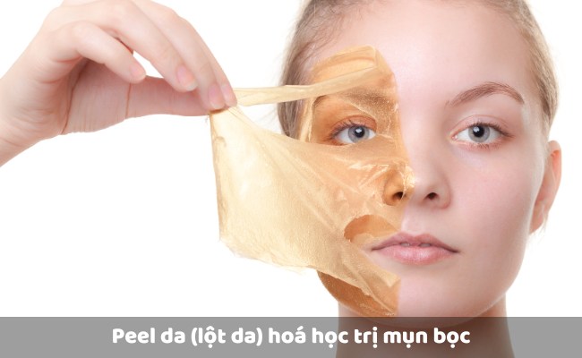 Peel da (lột da) hoá học trị mụn bọc

