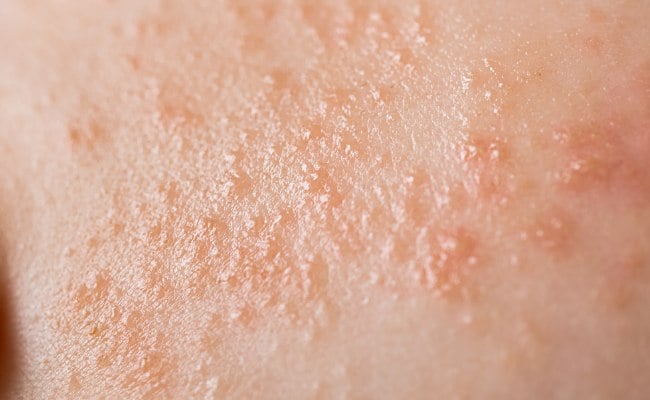 Nổi đốm đỏ trên da không ngứa do phát ban nhiệt

