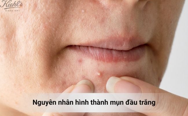 Nguyên nhân hình thành mụn đầu trắng