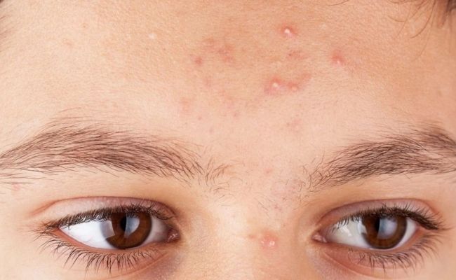 Mụn đầu trắng tuổi dậy thì