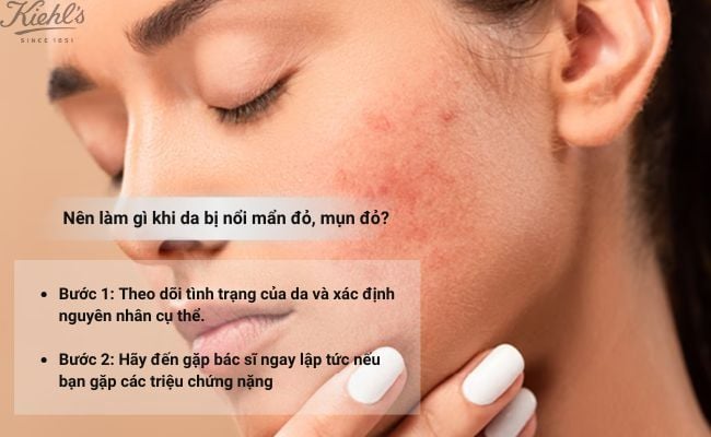 Nên làm gì khi da bị nổi mẩn đỏ, mụn đỏ