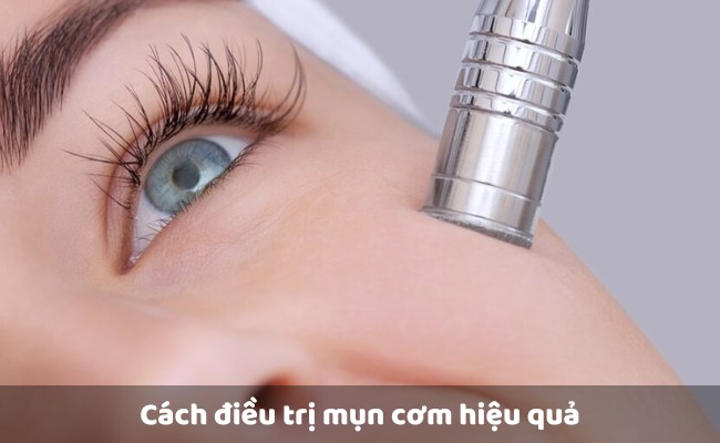 Cách điều trị mụn cơm hiệu quả

