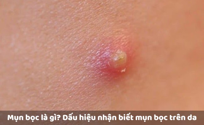 Mụn bọc là gì? Dấu hiệu nhận biết mụn bọc trên da
