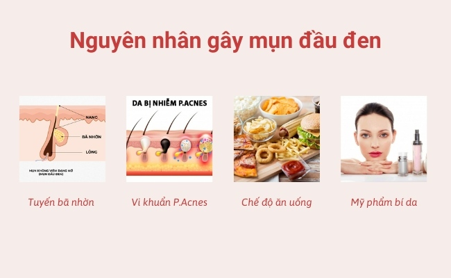 Nguyên nhân gây mụn đầu đen