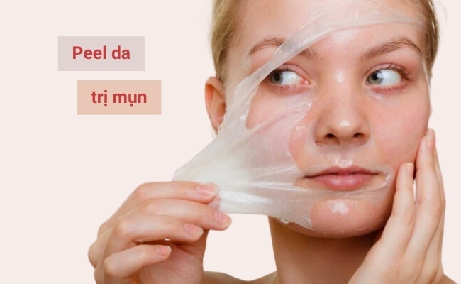 Peel da hóa học trị mụn đầu đen