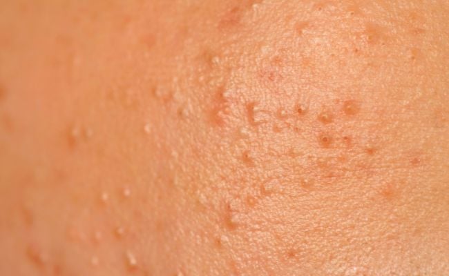 Nguyên nhân khiến da bị Purging là gì?