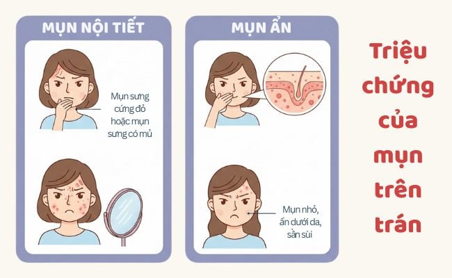 Triệu chứng thường gặp của mụn trên trán