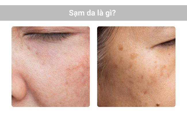 Sạm da là gì