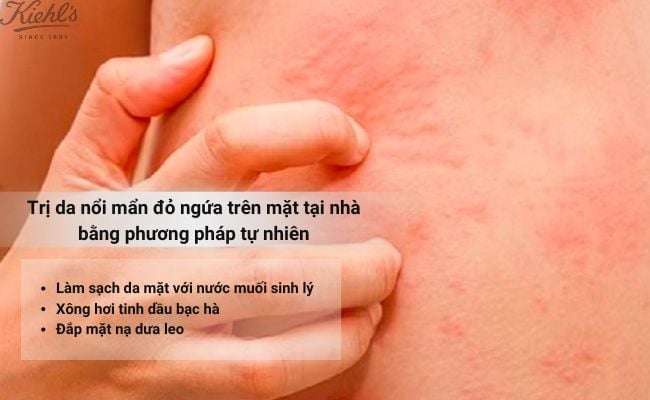 Cách trị da nổi mẩn đỏ ngứa trên mặt tại nhà bằng phương pháp tự nhiên