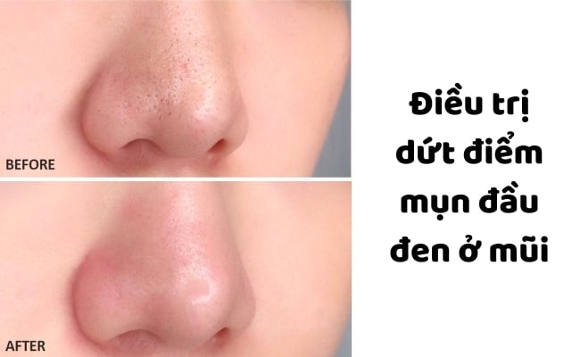 Điều trị dứt điểm mụn đầu đen hiệu quả cao