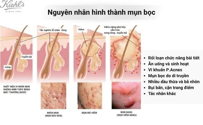 Nguyên nhân hình thành mụn bọc
