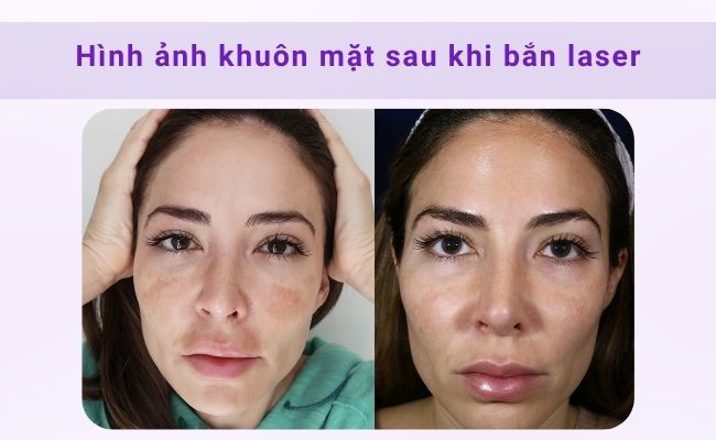 Điều trị nám bằng laser hiệu quả