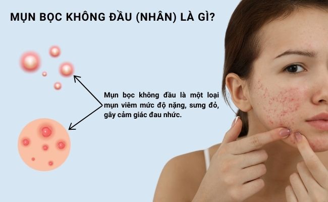Mụn bọc không đầu là gì?