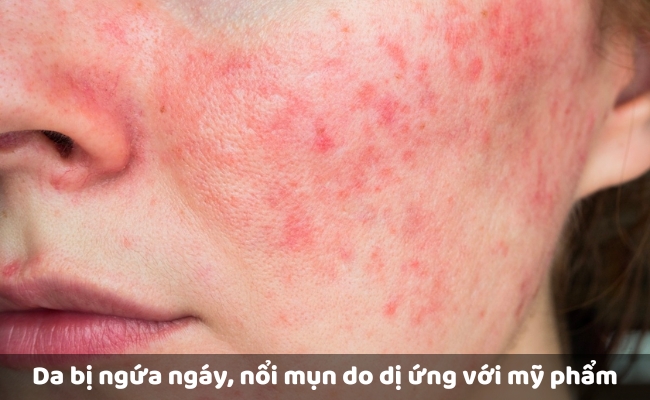 Da bị ngứa ngáy, nổi mụn do dị ứng với mỹ phẩm