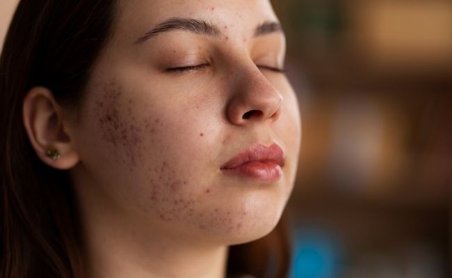 Nguyên nhân gây mụn tuổi dậy thì