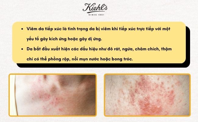 Viêm da tiếp xúc khá phổ biến ở những người có da nhạy cảm