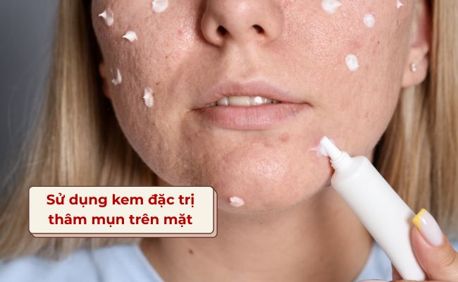 Sử dụng kem đặc trị thâm mụn trên mặt