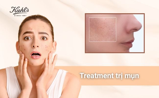 Treatment trị mụn là gì?