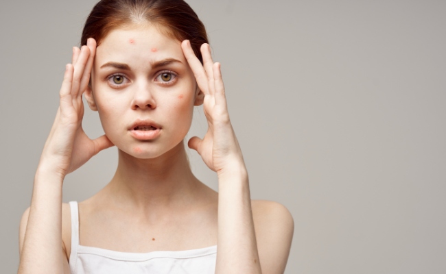 Đối tượng sử dụng Benzoyl Peroxide