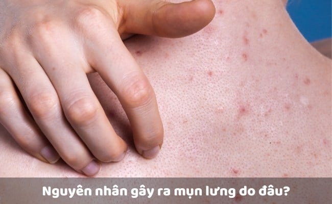 Nguyên nhân gây ra mụn lưng do đâu?

