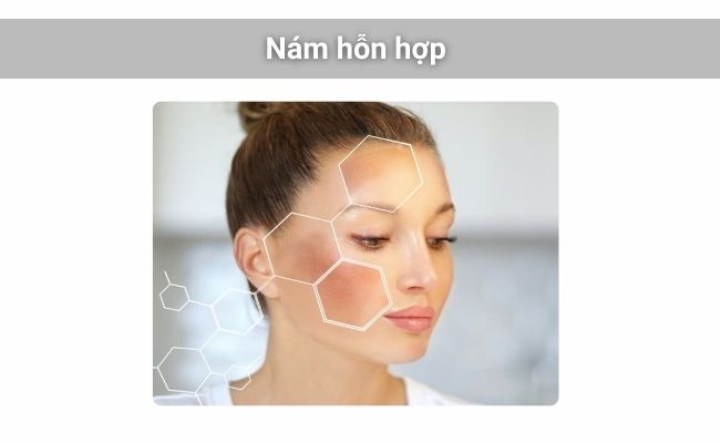 Nám hỗn hợp là tình trạng da xuất hiện đồng thời nám mảng nhạt màu và đốm nám sẫm màu rải rác