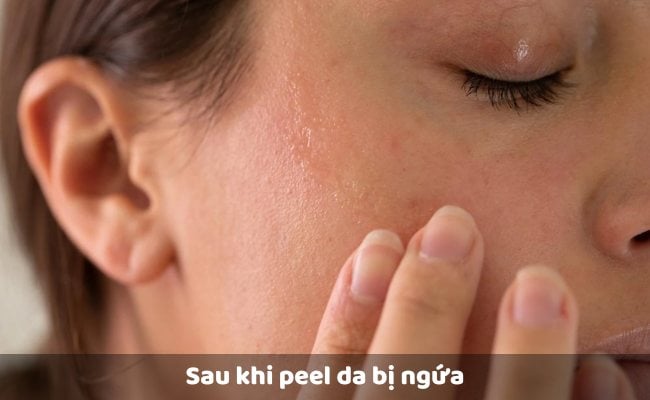 Sau khi peel da bị ngứa

