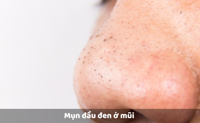 Các loại mụn ở mũi - Mụn đầu đen


