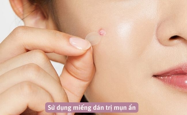 Mới nặn mụn xong nên làm gì để hết thâm sẹo?