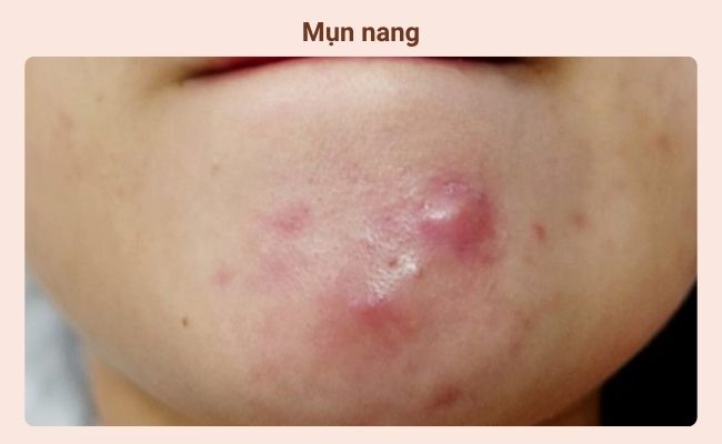 Mụn nang